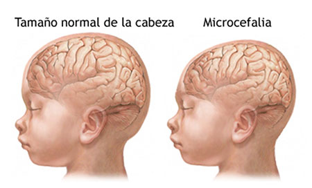 Microcefalia