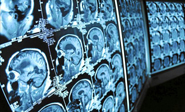 Nueva prueba identifica el riesgo de Alzheimer con 90% de exactitud