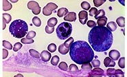 Convierten células de cáncer en inofensivos glóbulos blancos